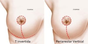 breast lift colombia